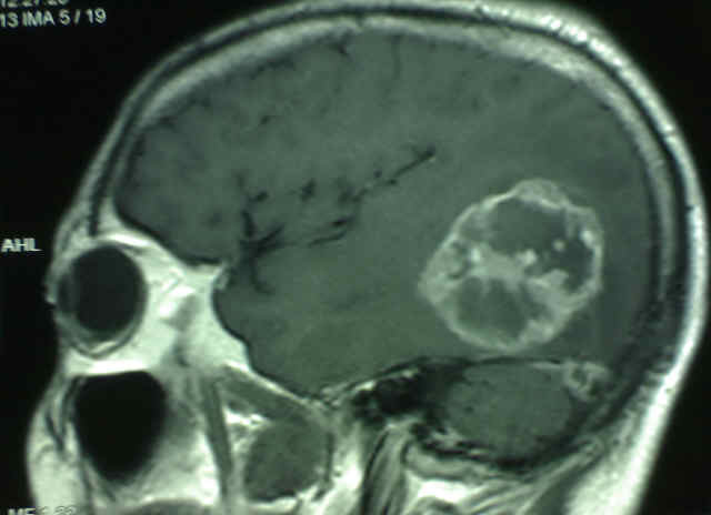 20110404120215-glioblastoma-multiforme.jpg